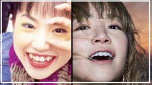 YUKIが顔変わったのは八重歯を直したから？年代別に比較してみた！