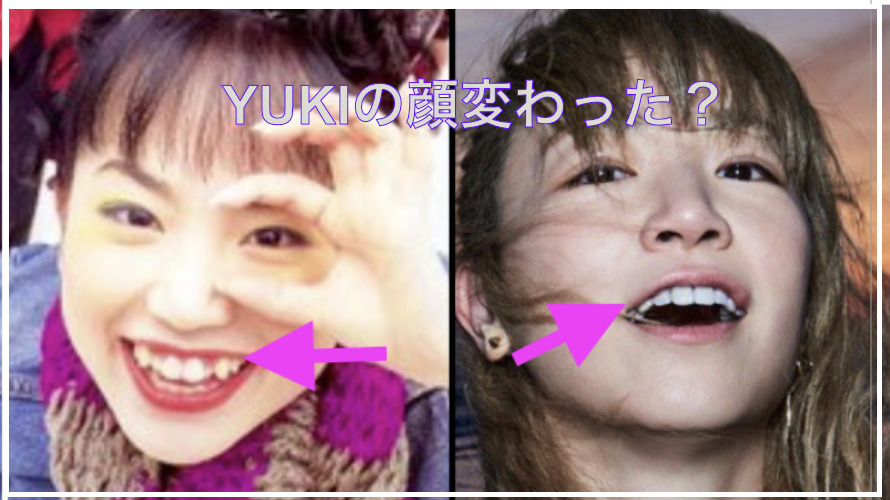 YUKIが顔変わったのは八重歯を直したから？年代別に比較してみた！